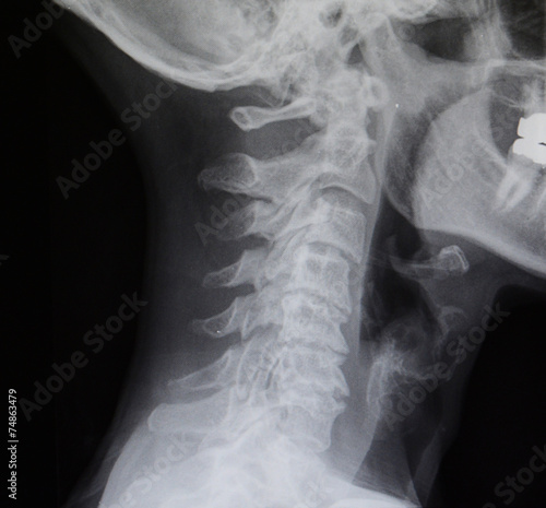 Human spine X-Ray