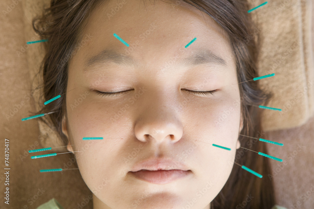 Obraz premium Facial acupuncture