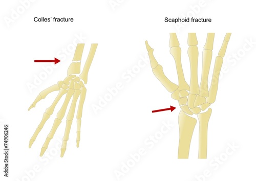 Fratture comuni dell'avambraccio e mano photo
