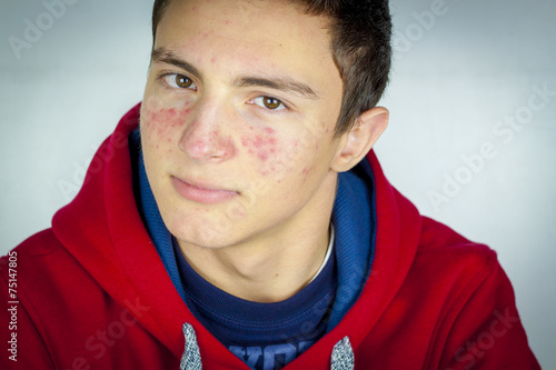 Portrait of teenage boy with acne photo