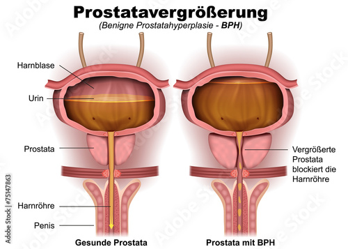 Prostatavergrößerung, BPH, anatomie illustration