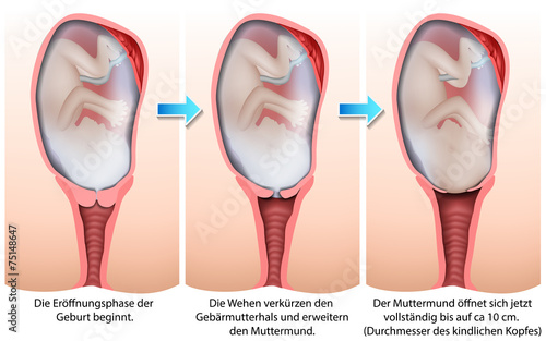 Die Eröffnungsphase der Geburt, medical illustration photo