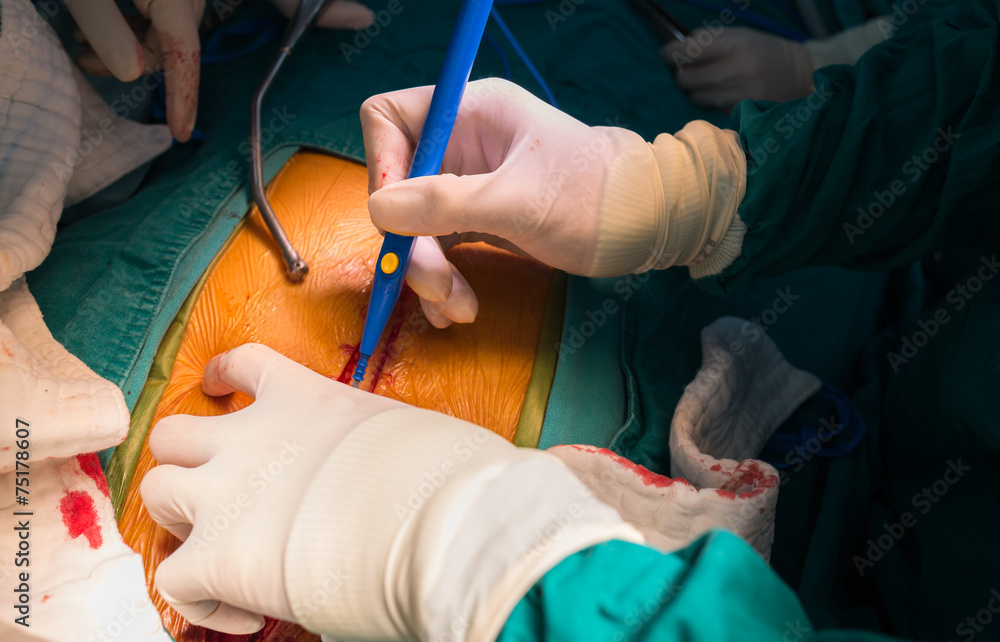 median sternotomy incision for open heart surgery median sternotomy incision for open heart surgery