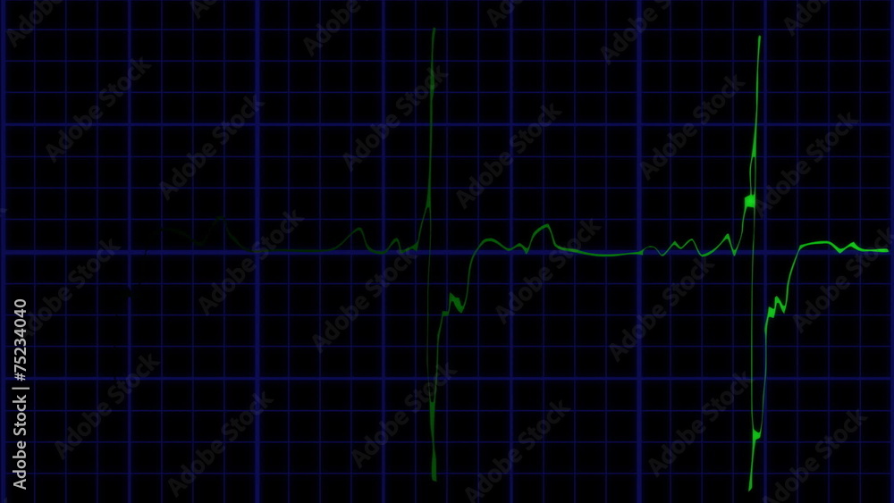 EKG true to life green on blue loopable EKG true to life green on blue loopable