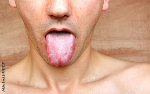 Infection tongue