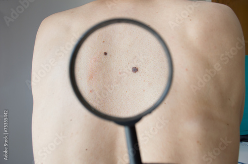Checking melanoma on the back of a man photo
