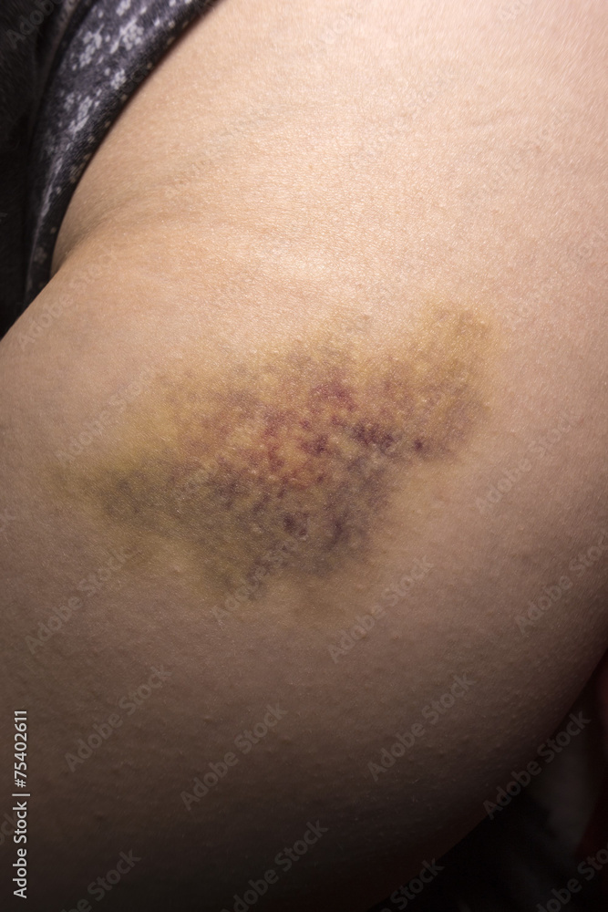 Fototapeta premium Woman leg bruise