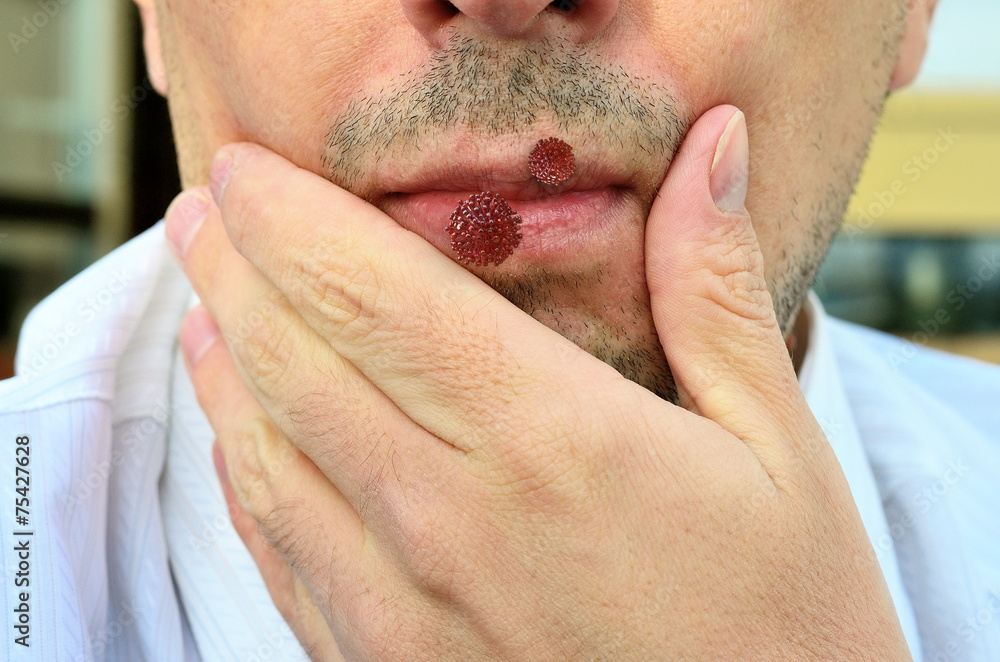 Naklejka premium Herpes simplex