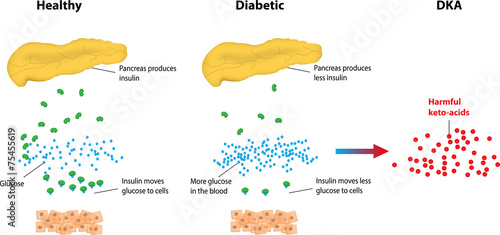 Diabetic Ketoacidosis photo