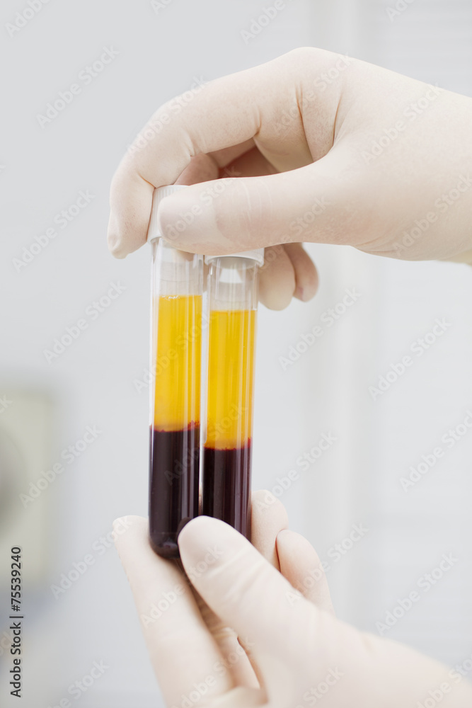 Blood tubes in two layers divided by centrifuge after Stock Photo