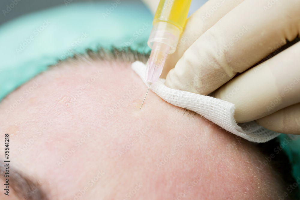 Beautician procedure Plasmolifting injection Beautician procedure Plasmolifting injection