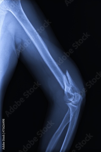 Obraz na płótnie Broken arm / elbow. w salonie