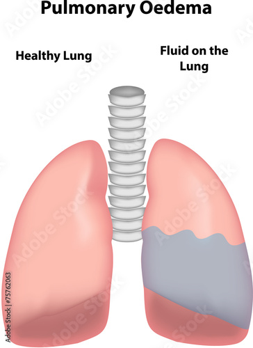 Fotografie Pulmonary Oedema