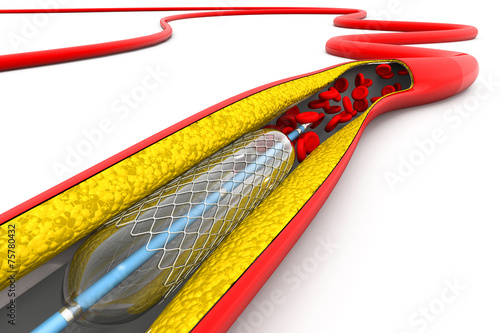 Bilde på lerret Stent angioplasty procedure with placing a balloon
