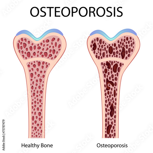Osteoporosis