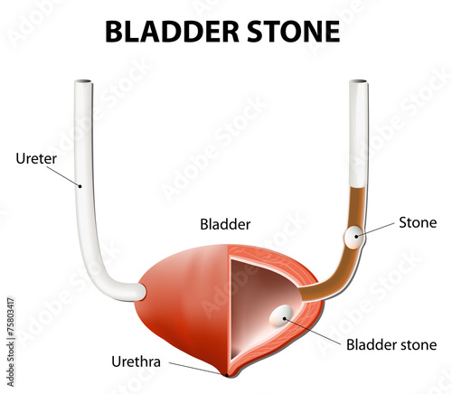 Stones in the urinary bladder and ureter