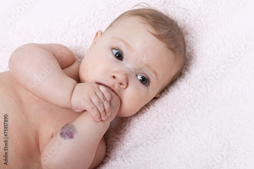 Cute baby girl with hemangioma on her arm