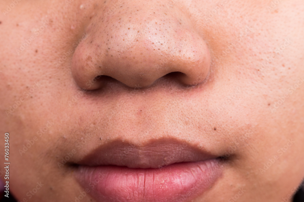 Obraz premium Pimple blackheads on the face of an Asian teenager