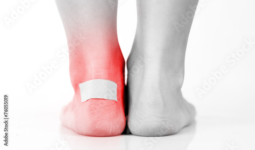 Closeup of woman's heel with blister plaster on