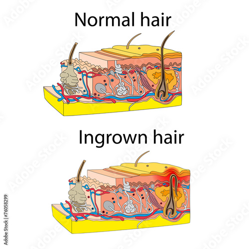 Skin with ingrown hair
