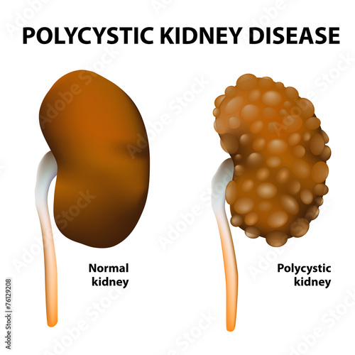 Polycystic kidney