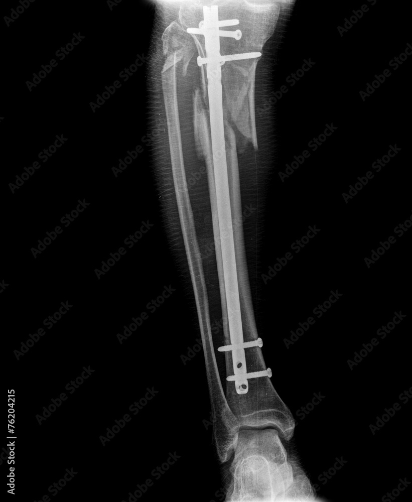 xray of leg with screw xray of leg with screw
