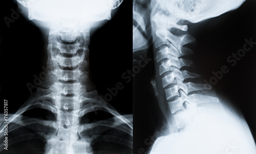 X-ray image of neck