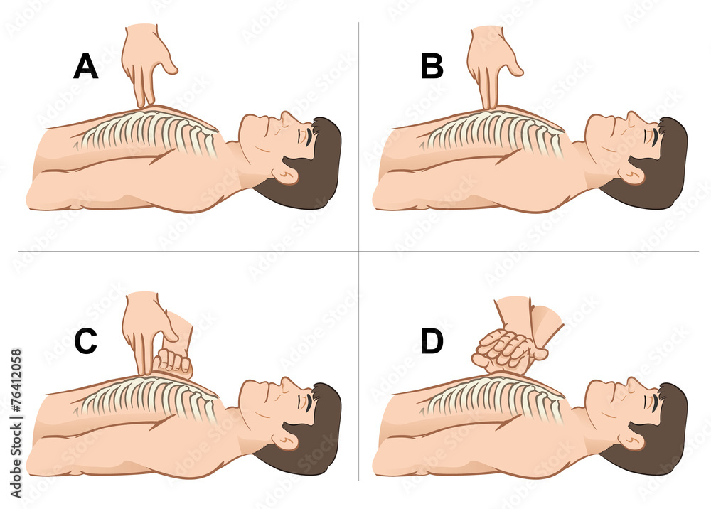 First Aid resuscitation (CPR), massage compression the chest Stock