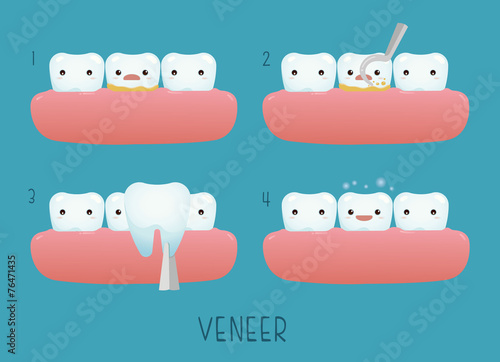 Veneer tooth of dental