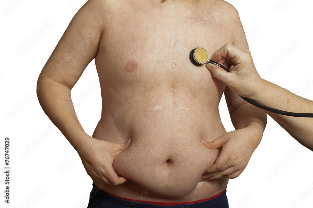 Naklejka premium child obesity scars on his body after heart surgery