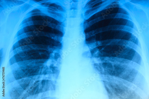X-ray image of chest photo