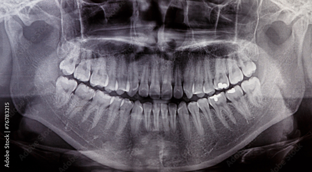 X-Ray scan human for teeth