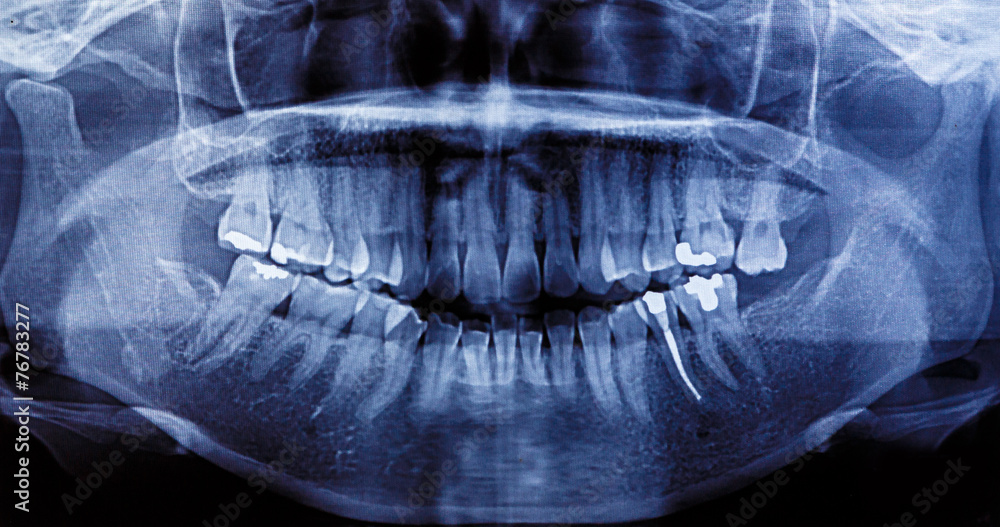X-Ray scan human for teeth