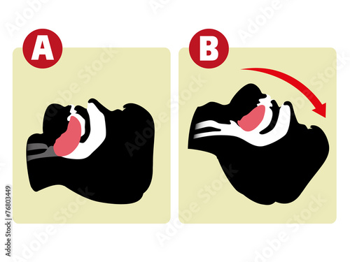 First Aid resuscitation (CPR), clearing breathing