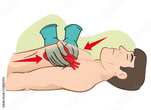 First Aid cardiac resuscitation (CPR), open heart massage