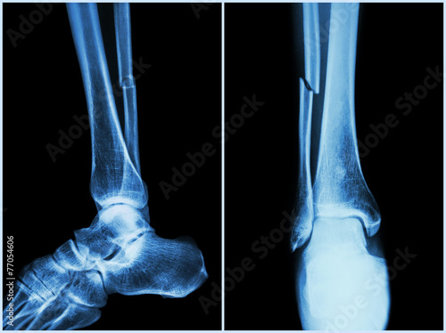 Canvas Print Fracture shaft of fibula bone ( leg bone ) .  X-ray of leg
