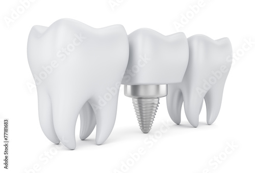 Teeth and dental implant