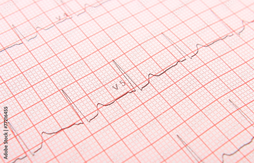 Electrocardiogram graph report Electrocardiogram graph report