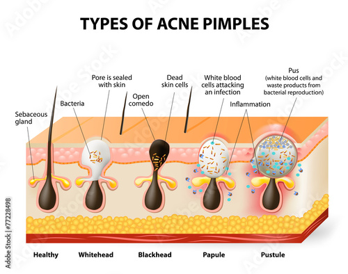 Types of acne pimples photo