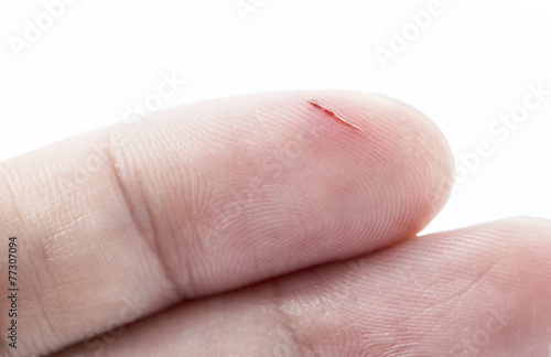 incision wound on finger with white background