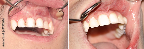 Caries before and after treatment