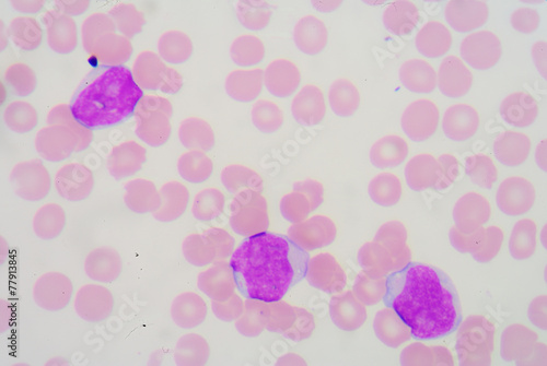 A blood smear is often used as a follow-up test to abnormal resu photo