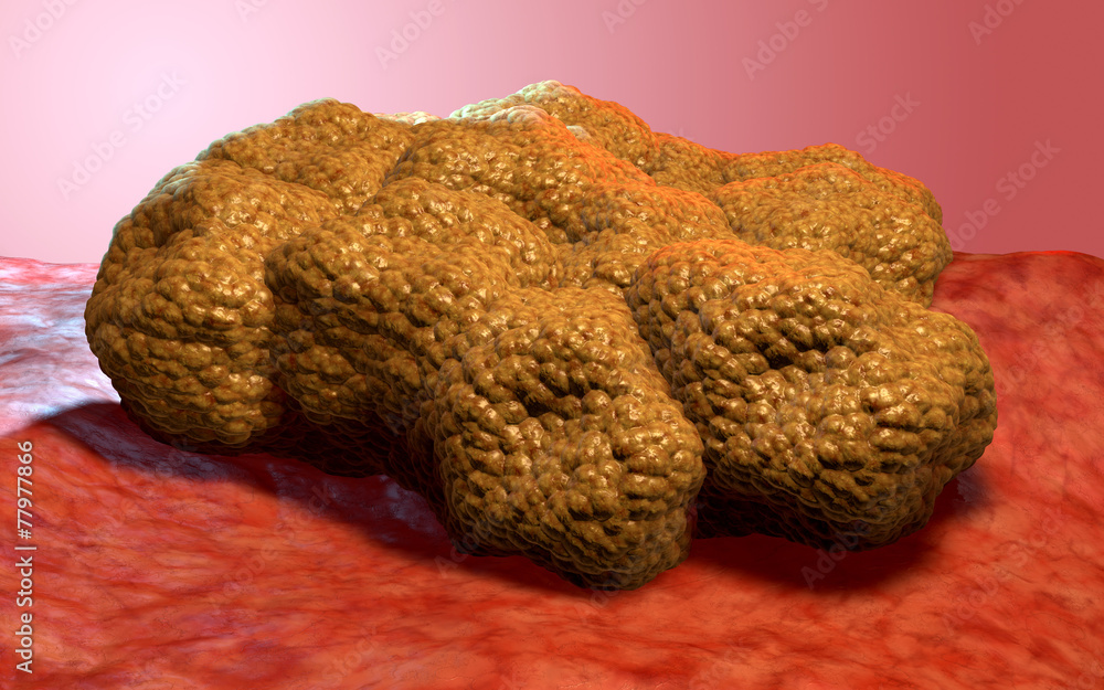 Fototapeta premium Cancer cell tumor, 3d medical illustration