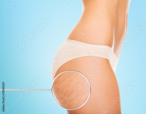 close up of woman buttocks with cellulite