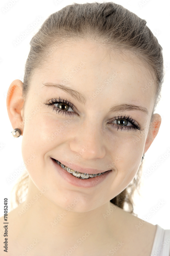 Teen mit Braces lächelt Stock Photo | Adobe Stock