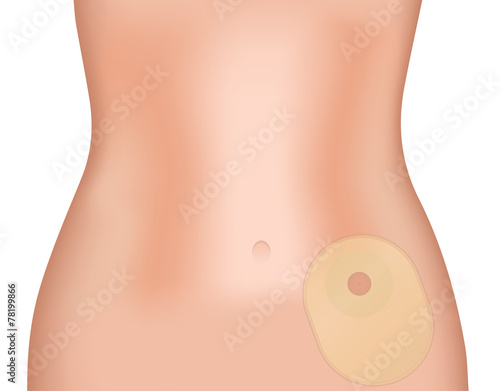 Colostomy Bag in Situ