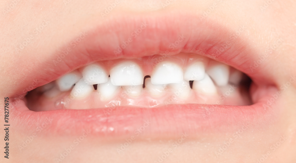 Obraz premium teeth in children. close-up