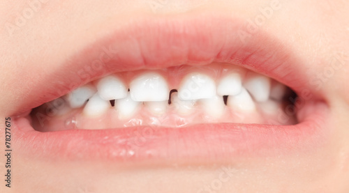 teeth in children. close-up