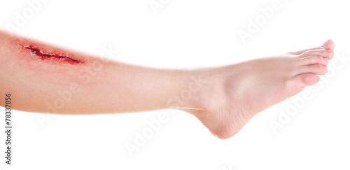 Cuadro en lienzo Injured leg with blood isolated on white