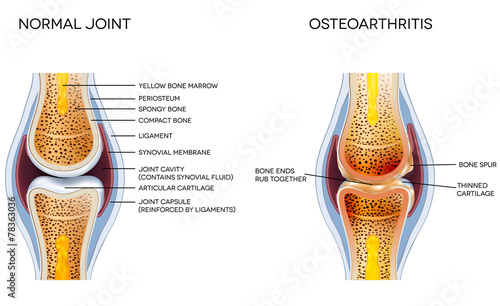 Osteoarthritis and normal joint anatomy